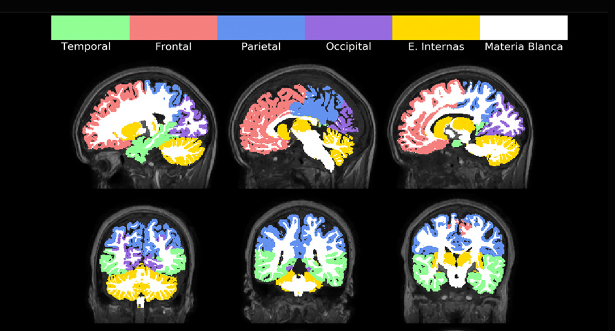 VOL Ayuda en radiología Proporcionando segmentación automática de todas las áreas cerebrales e identificación de atrofias y lesiones